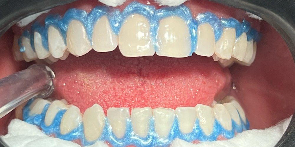 Antes do tratamento — Estética Dental