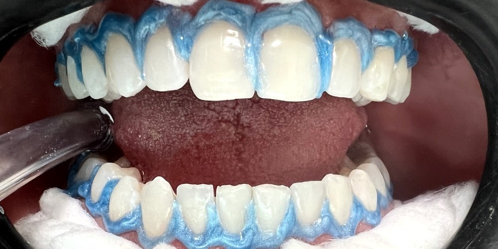 Depois do tratamento — Estética Dental