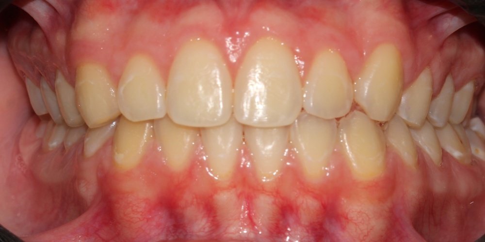 Antes do tratamento — Estética Dental