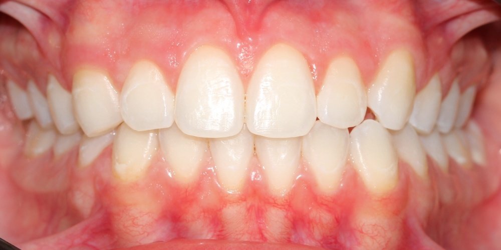 Depois do tratamento — Estética Dental