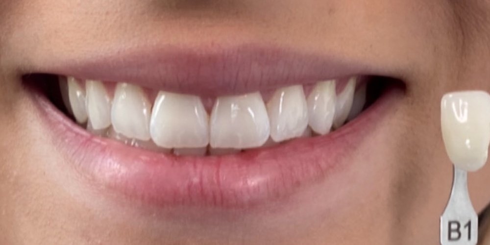 Antes do tratamento — Estética Dental