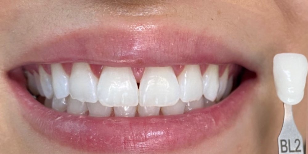 Depois do tratamento — Estética Dental