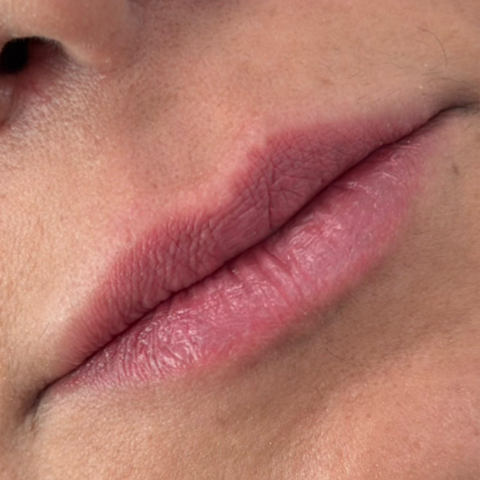 Antes do tratamento — Harmonização Orofacial