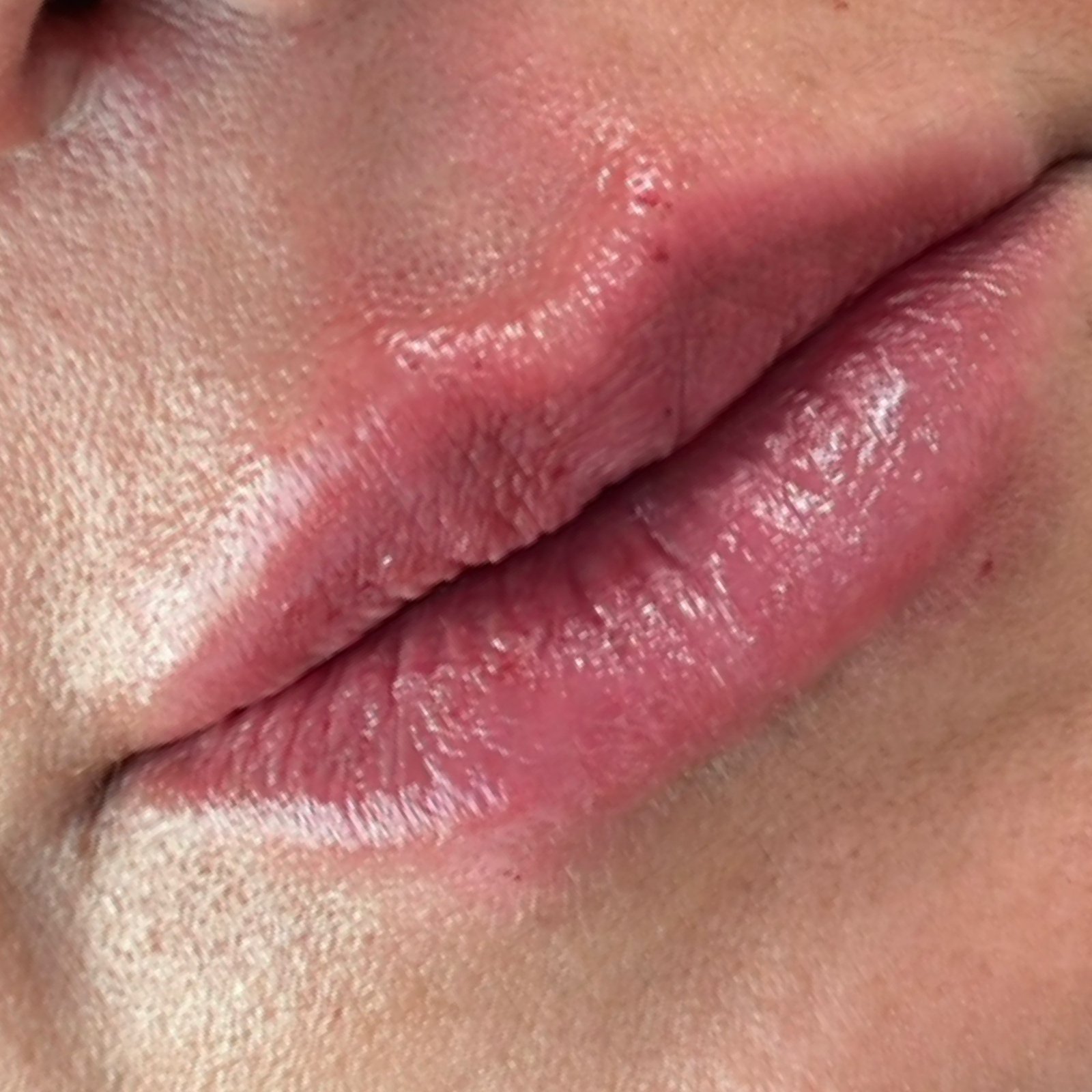 Depois do tratamento — Harmonização Orofacial