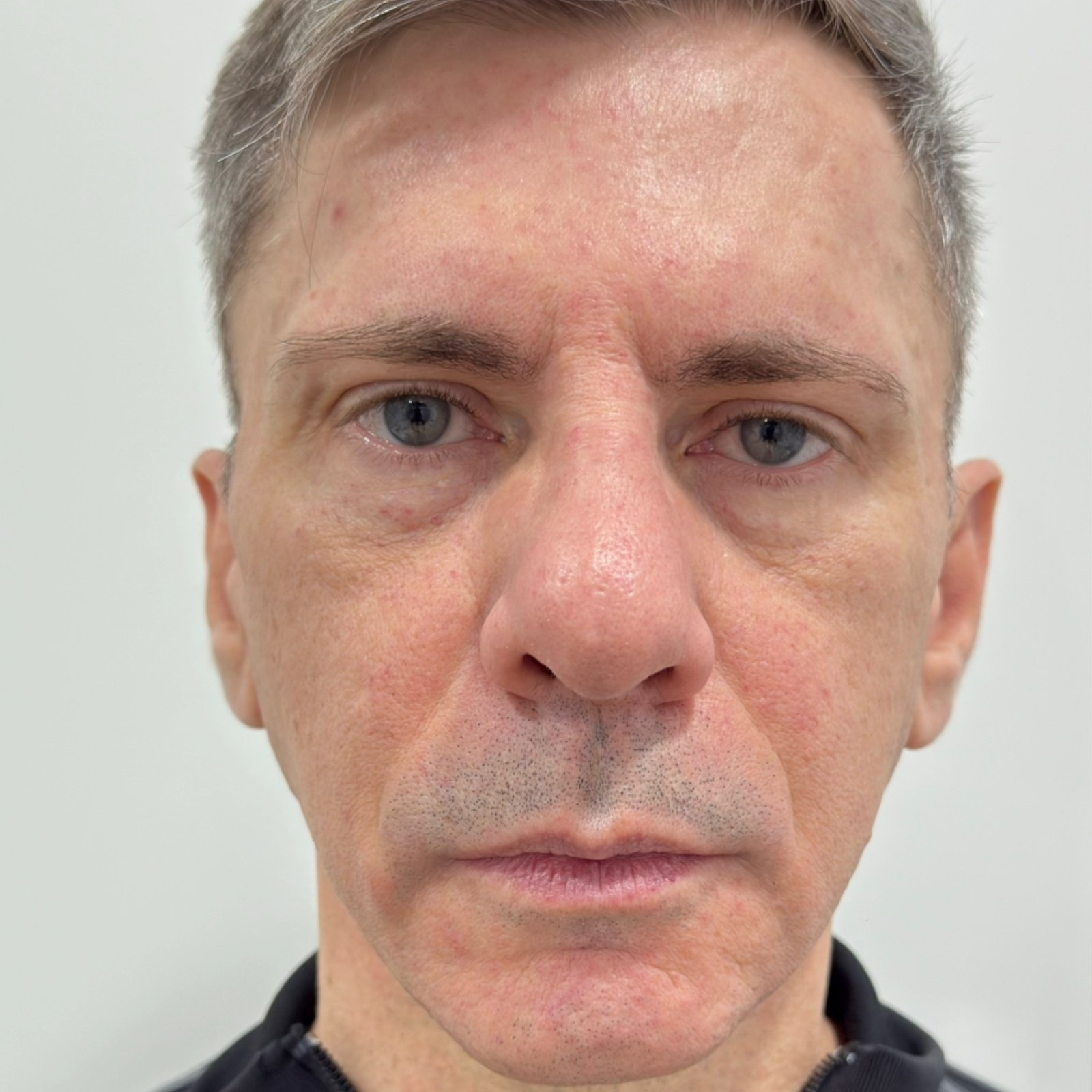 Antes do tratamento — Harmonização Orofacial