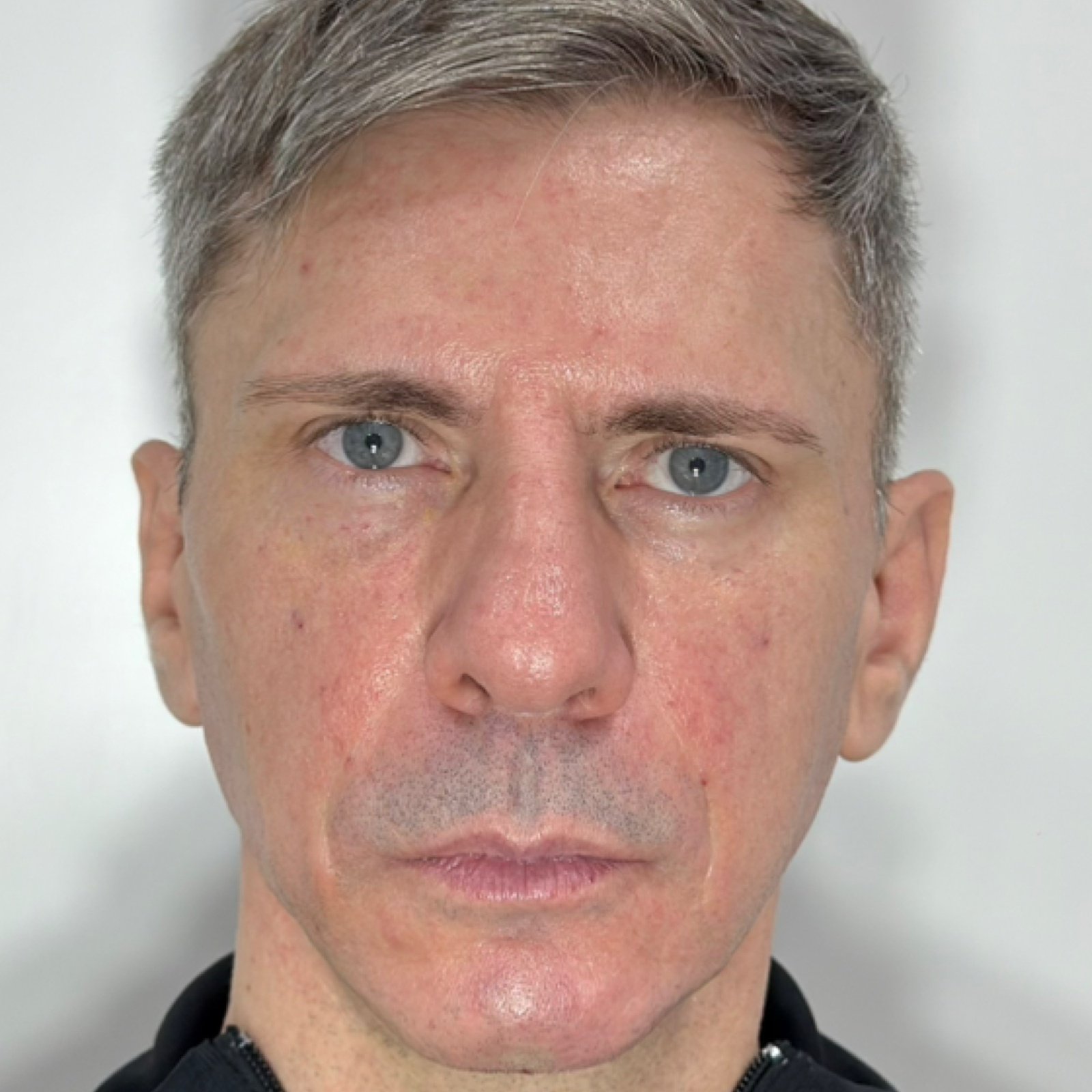 Depois do tratamento — Harmonização Orofacial