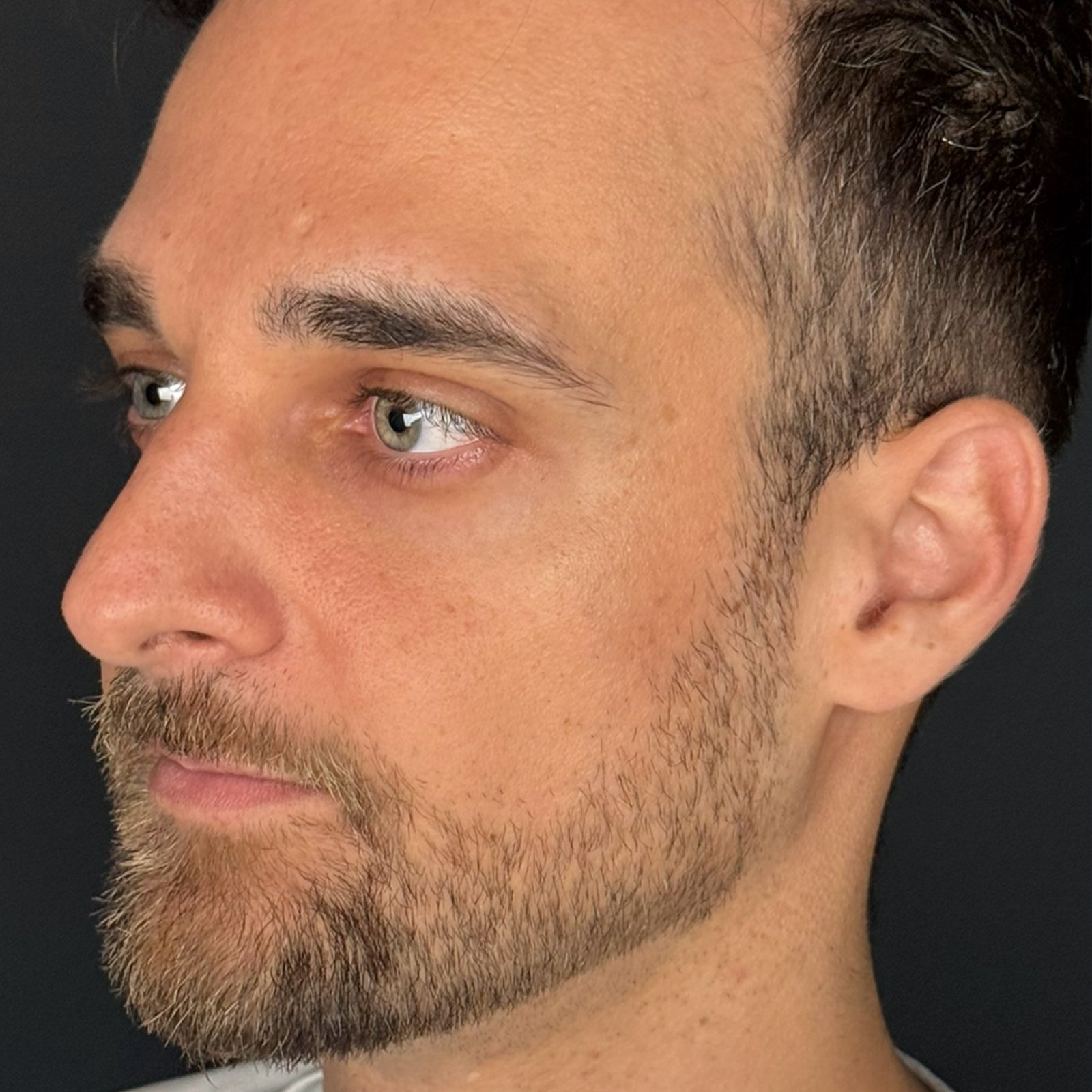 Antes do tratamento — Harmonização Orofacial
