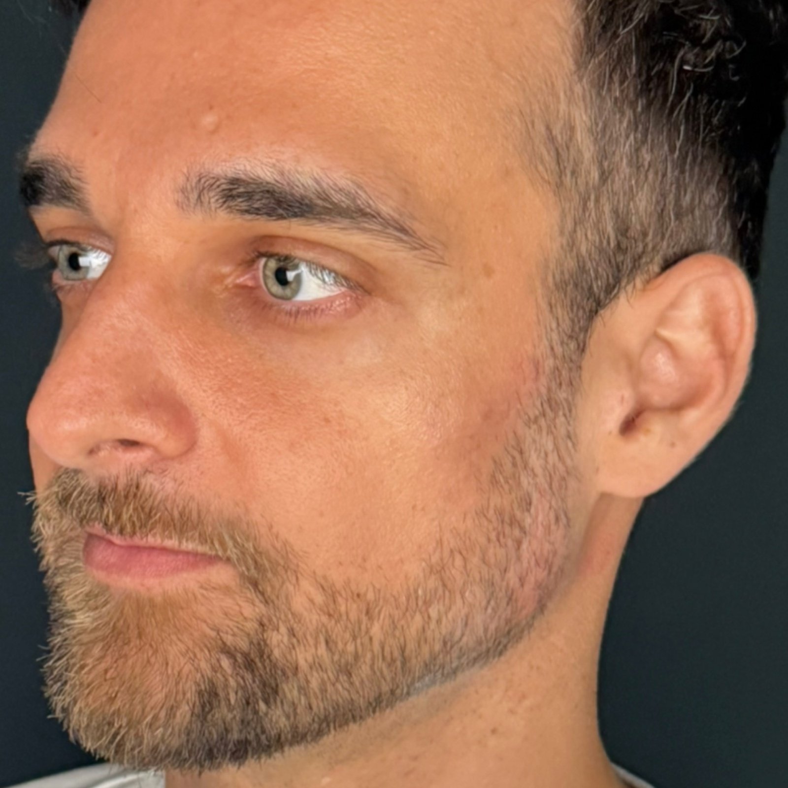 Depois do tratamento — Harmonização Orofacial