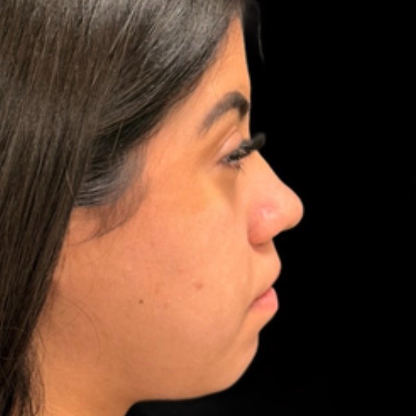 Antes do tratamento — Harmonização Orofacial