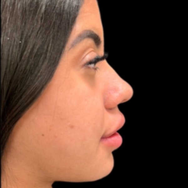 Depois do tratamento — Harmonização Orofacial