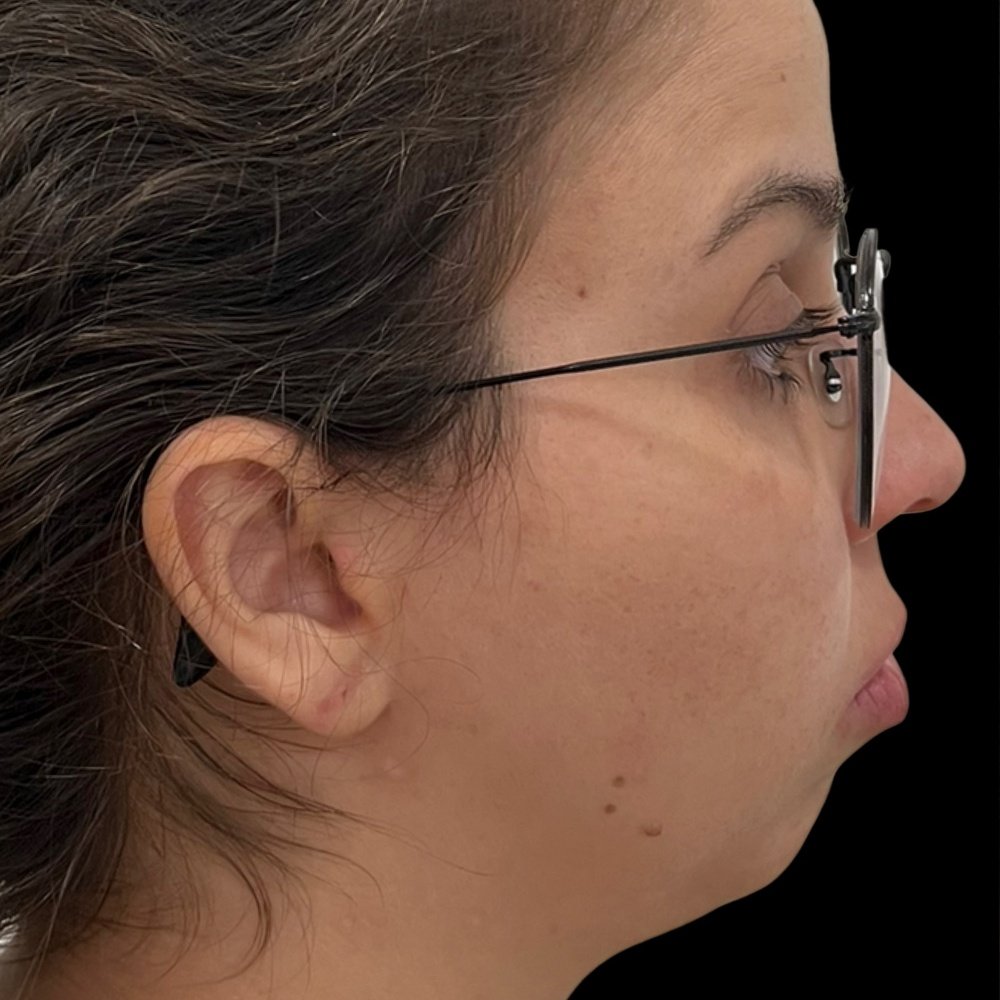 Antes do tratamento — Harmonização Orofacial