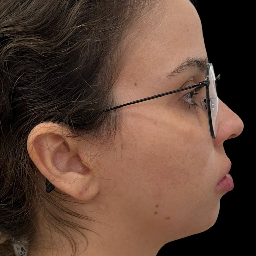 Depois do tratamento — Harmonização Orofacial