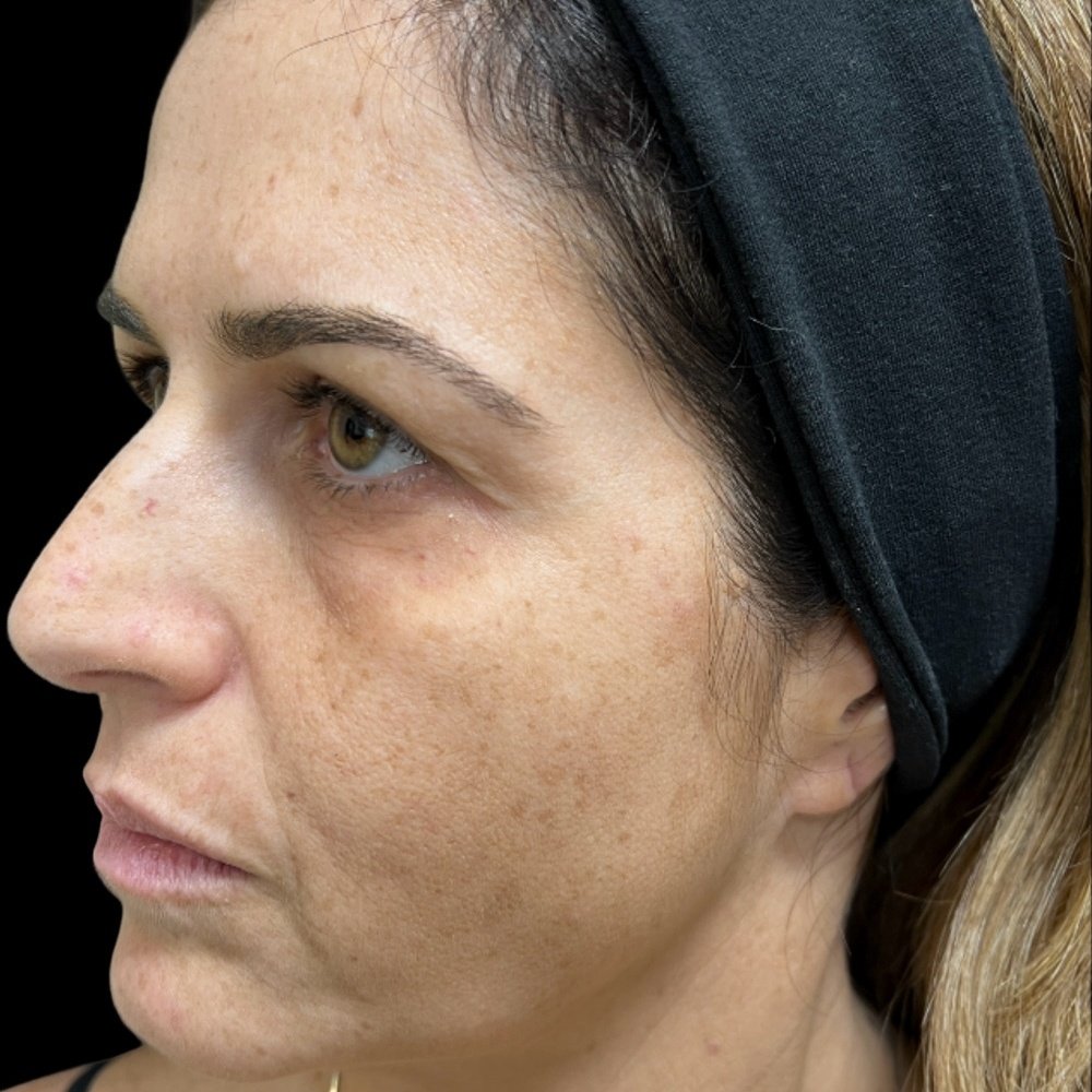 Antes do tratamento — Harmonização Orofacial