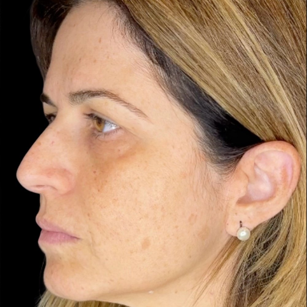 Depois do tratamento — Harmonização Orofacial
