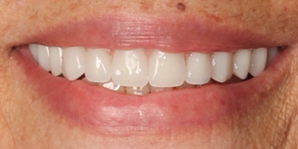 Depois do tratamento — Implantes Dentários