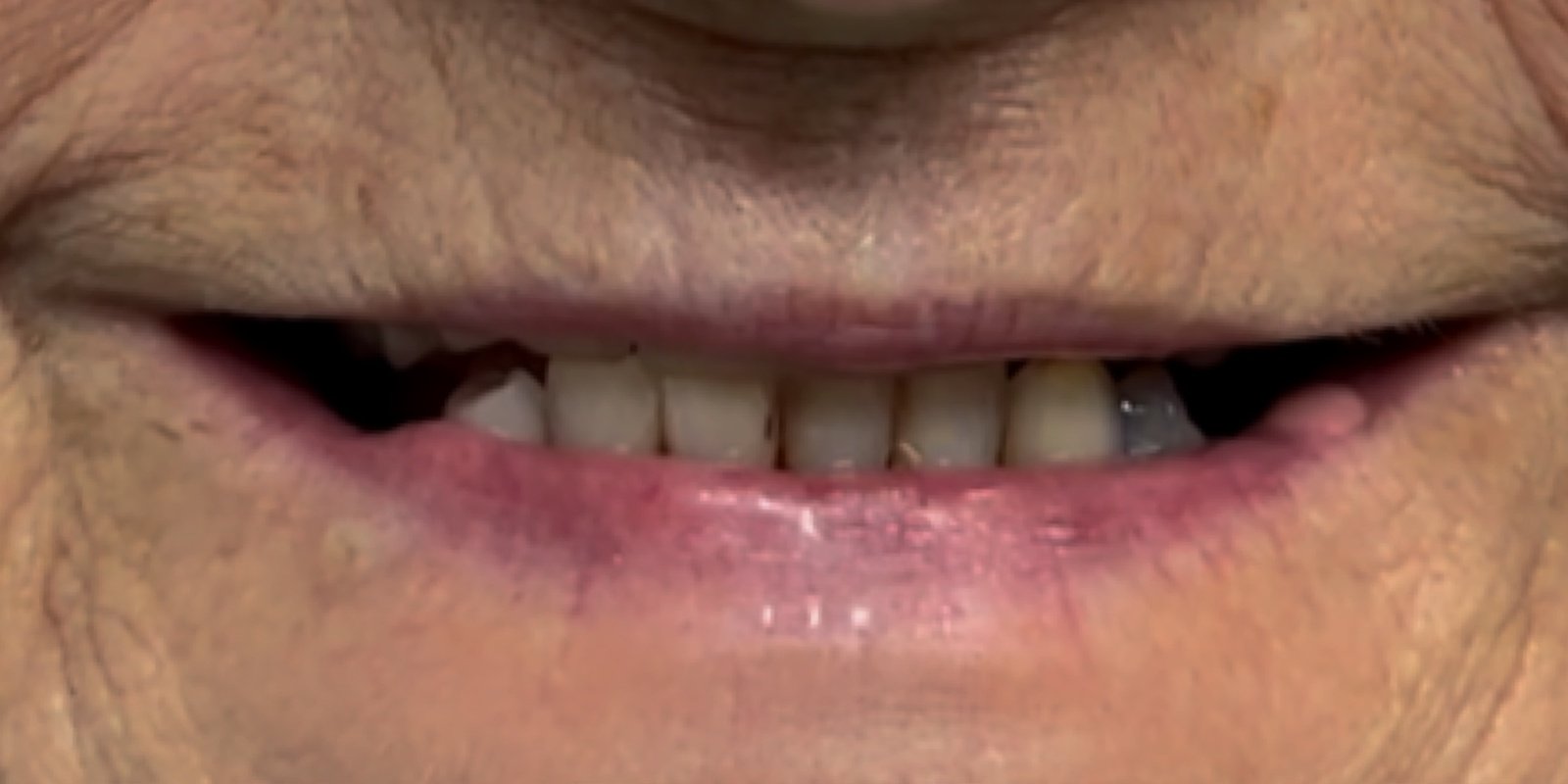Antes do tratamento — Implantes Dentários