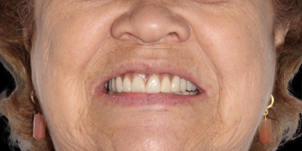 Antes do tratamento — Implantes Dentários