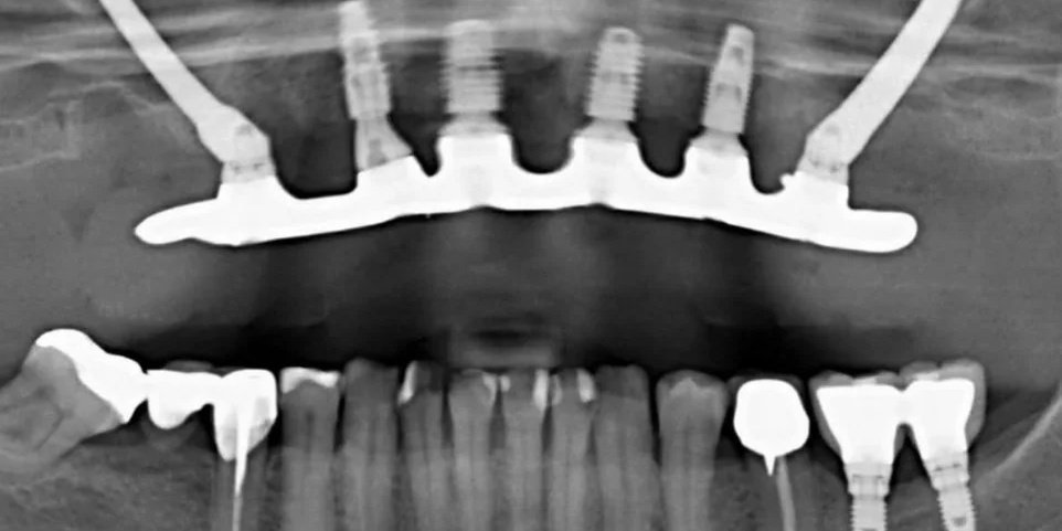 Depois do tratamento — Implantes Dentários