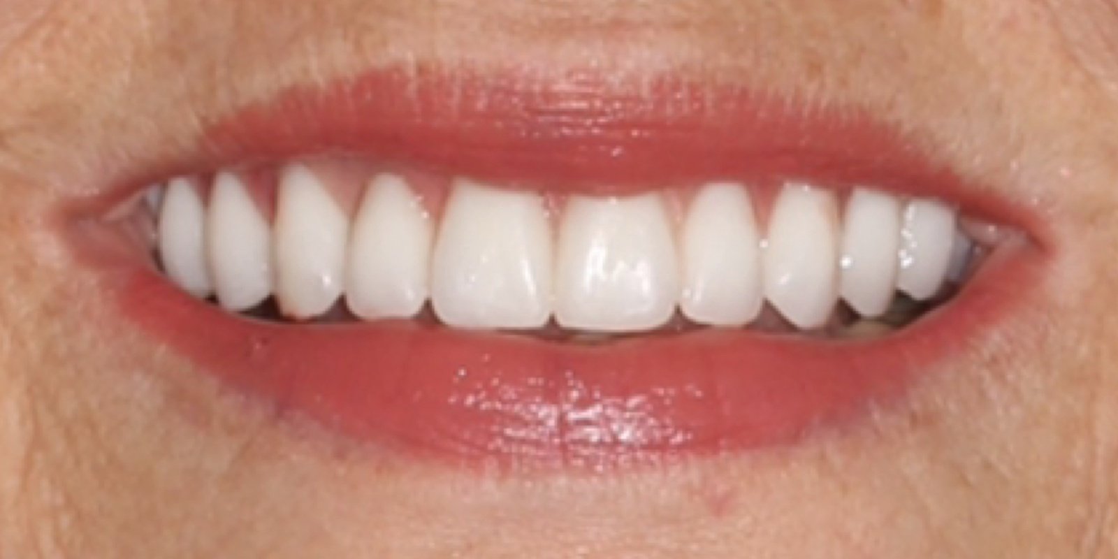 Depois do tratamento — Implantes Dentários