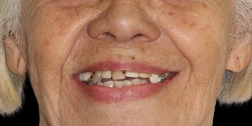 Antes do tratamento — Implantes Dentários
