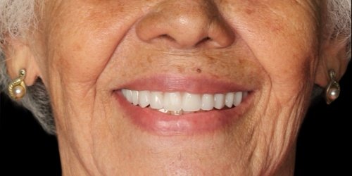 Depois do tratamento — Implantes Dentários