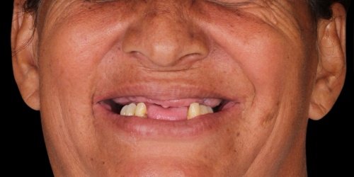 Antes do tratamento — Implantes Dentários