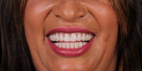 Depois do tratamento — Implantes Dentários