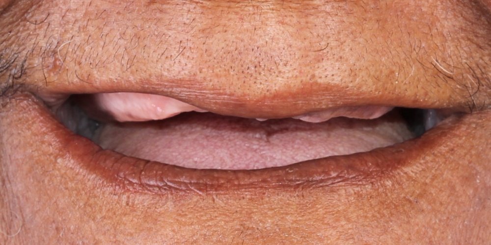 Antes do tratamento — Implantes Dentários