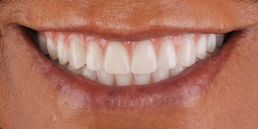 Depois do tratamento — Implantes Dentários