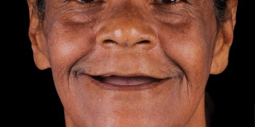 Antes do tratamento — Implantes Dentários