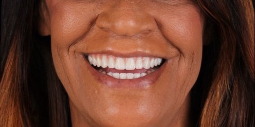 Depois do tratamento — Implantes Dentários