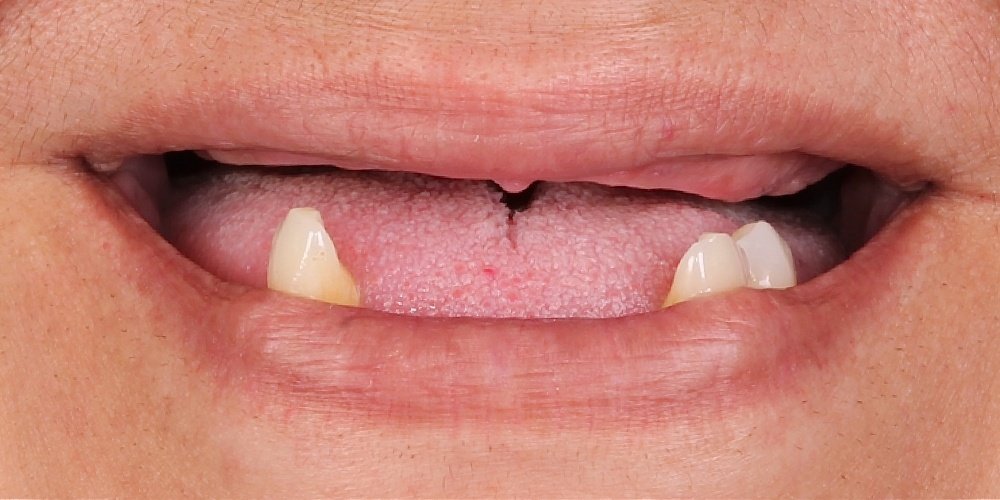 Antes do tratamento — Implantes Dentários