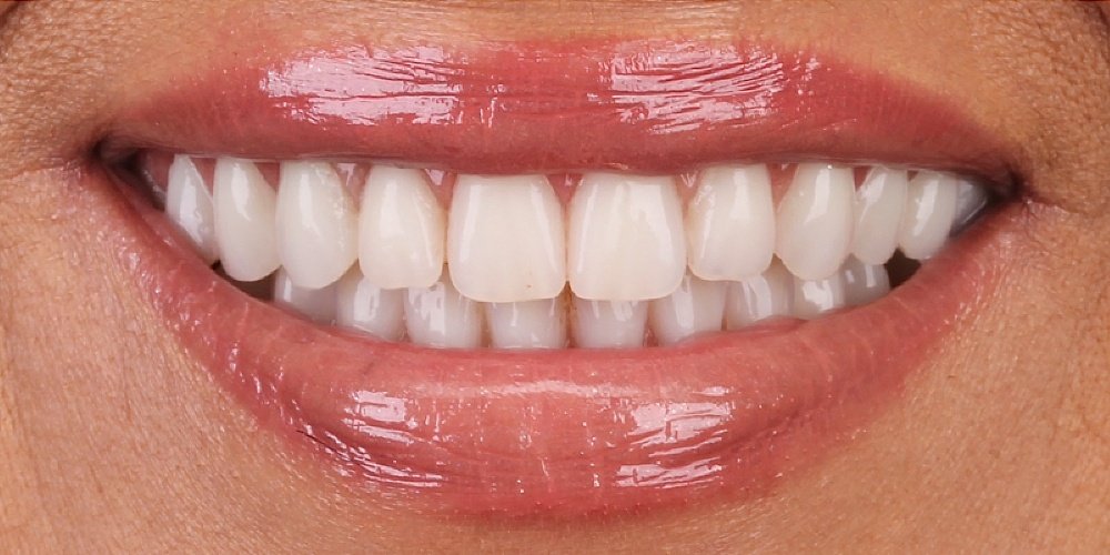 Depois do tratamento — Implantes Dentários