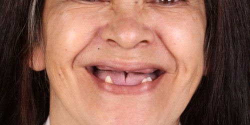 Antes do tratamento — Implantes Dentários