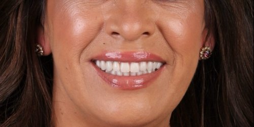 Depois do tratamento — Implantes Dentários