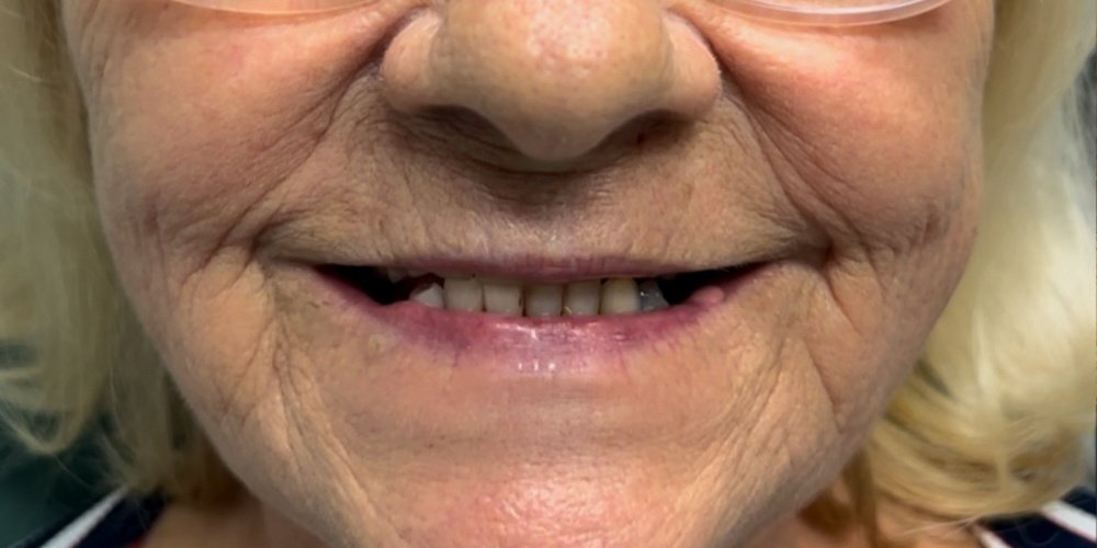 Antes do tratamento — Implantes Dentários