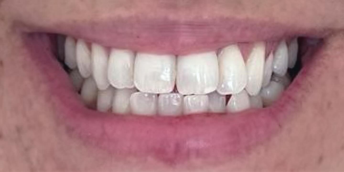 Antes do tratamento — Invisalign