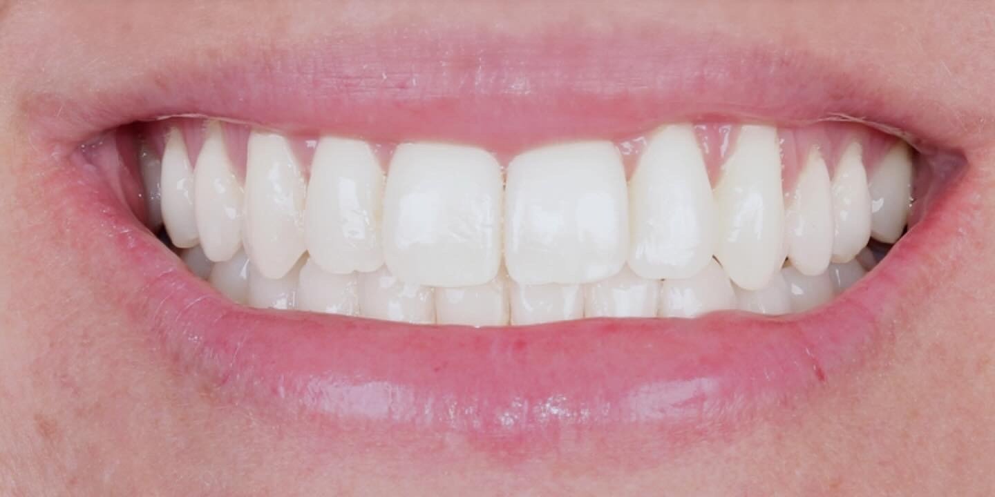 Depois do tratamento — Invisalign