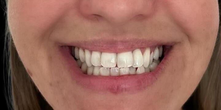Antes do tratamento — Invisalign