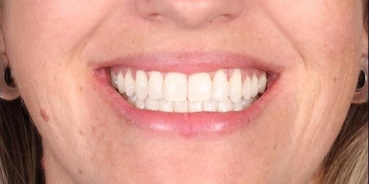 Depois do tratamento — Invisalign