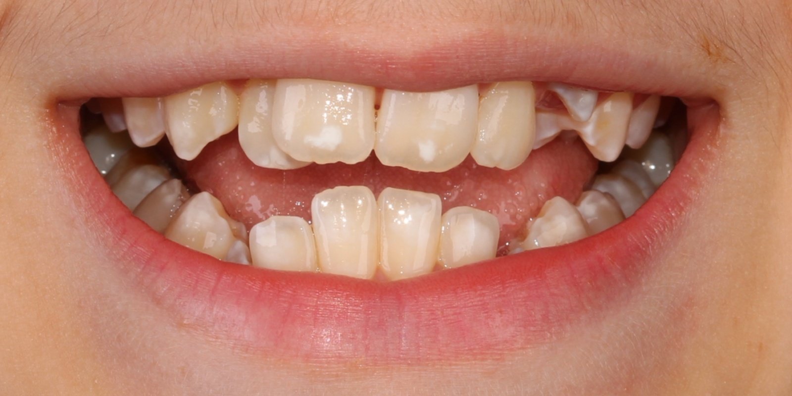 Antes do tratamento — Invisalign