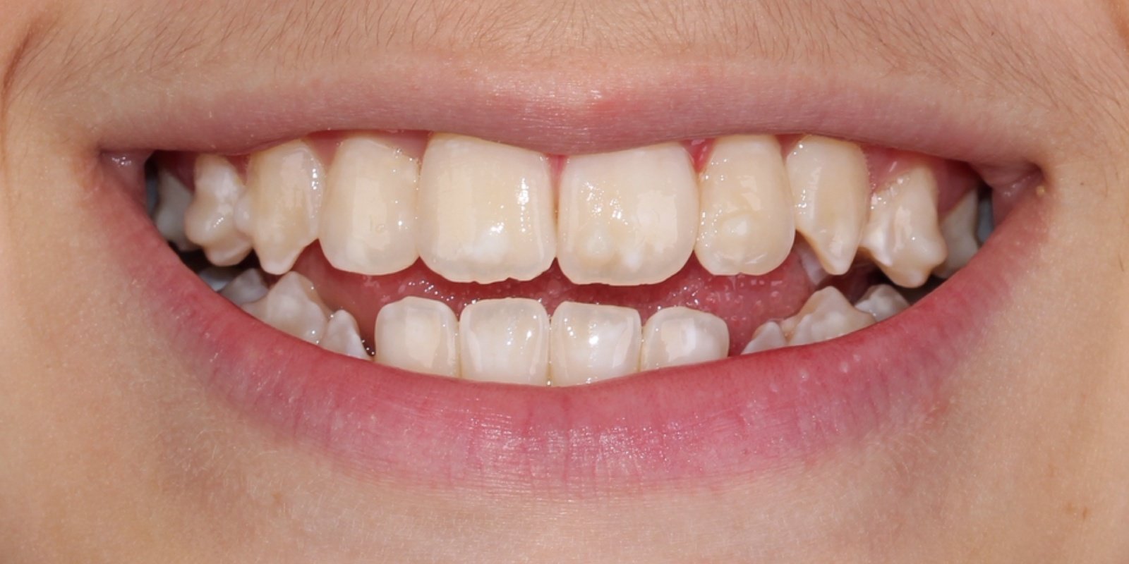Depois do tratamento — Invisalign