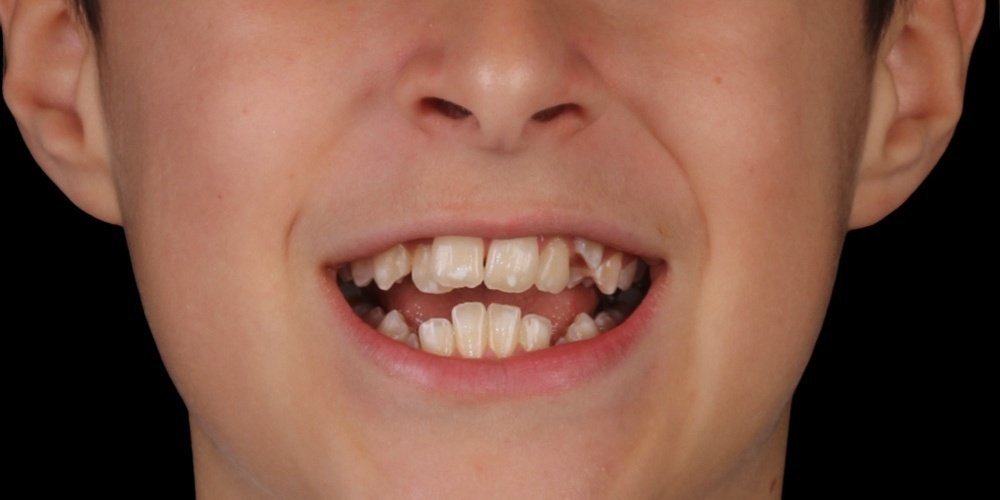Antes do tratamento — Invisalign