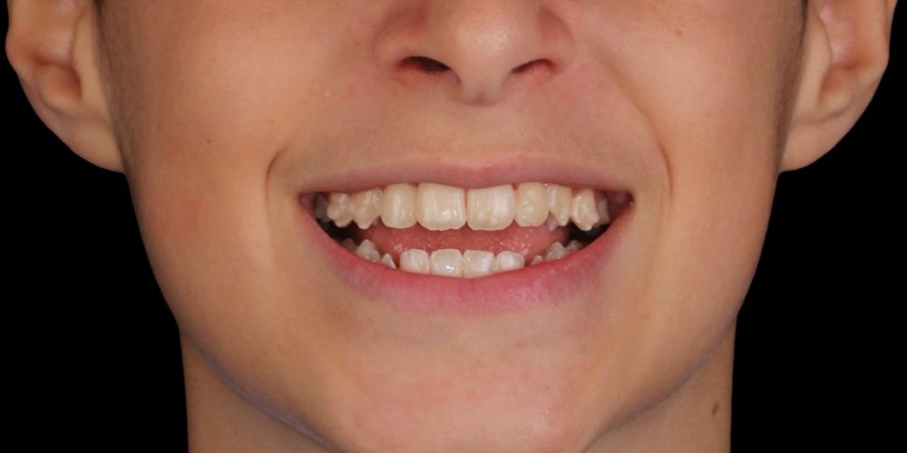 Depois do tratamento — Invisalign