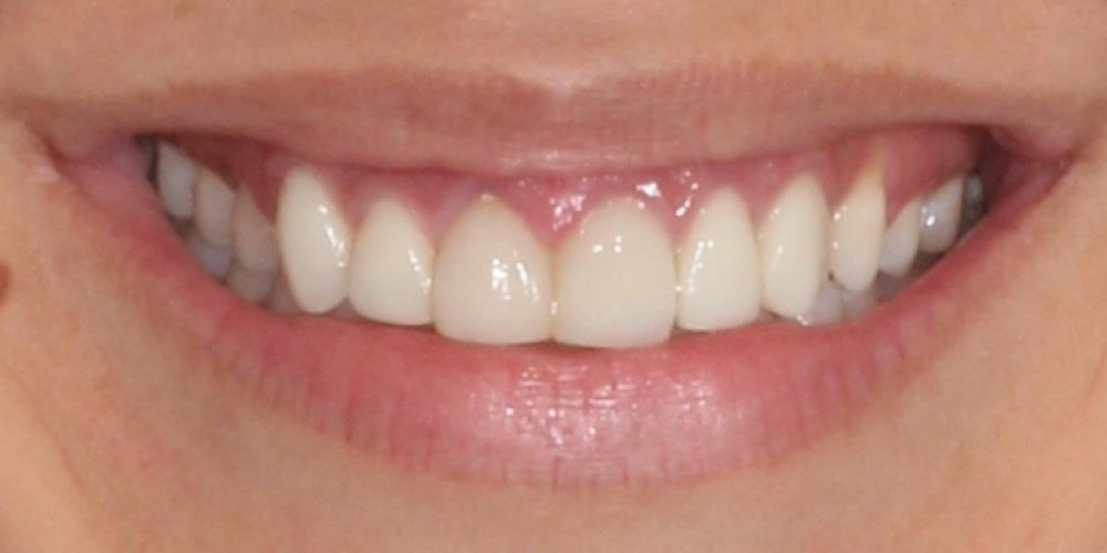 Antes do tratamento — Lentes de Contato Dental