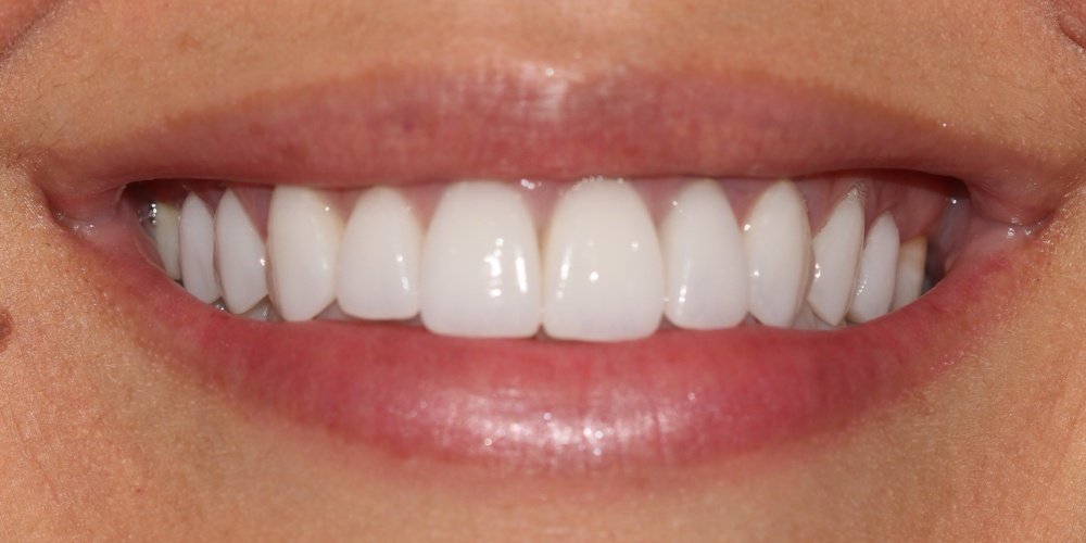 Depois do tratamento — Lentes de Contato Dental