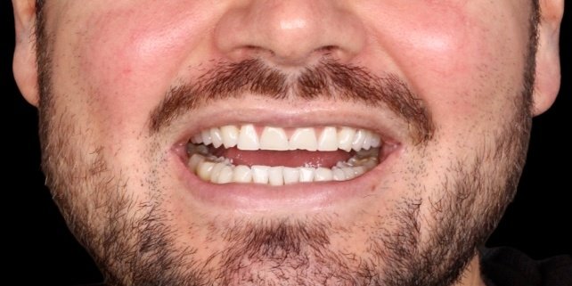 Antes do tratamento — Lentes de Contato Dental