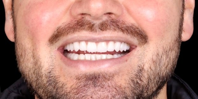 Depois do tratamento — Lentes de Contato Dental