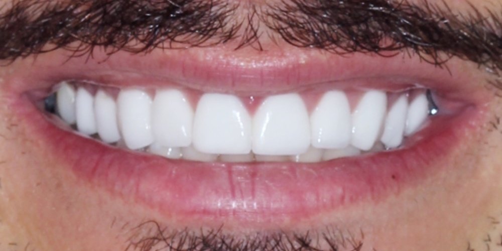 Antes do tratamento — Lentes de Contato Dental