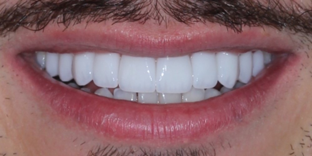 Depois do tratamento — Lentes de Contato Dental